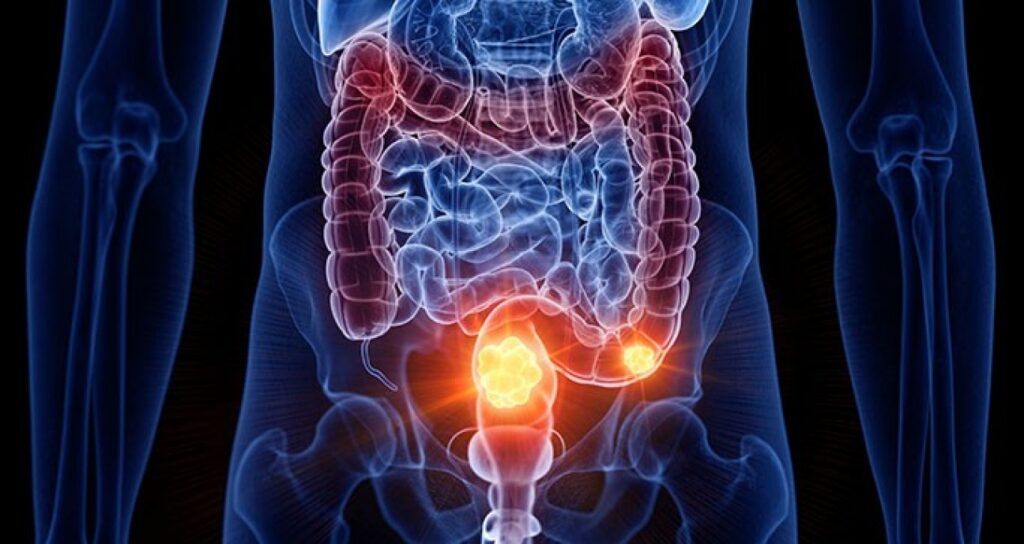 Colon Cancer Symptoms – Bowel Changes You Must Report