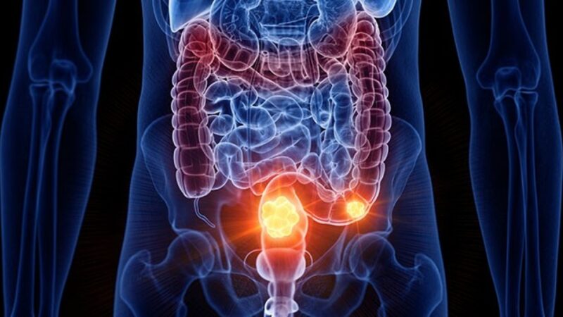 Colon Cancer Symptoms – Bowel Changes You Must Report