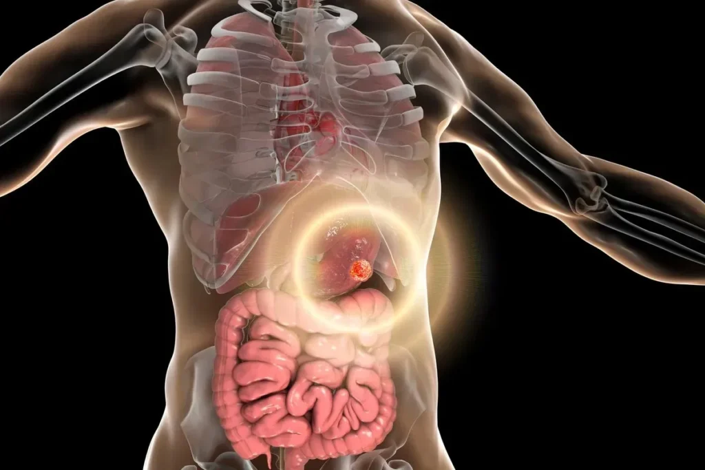 Stomach Cancer Symptoms – Digestive Signs Mistaken For Gastritis