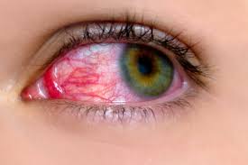 Conjunctivitis Symptoms: Red, Itchy Eyes Explained Simply