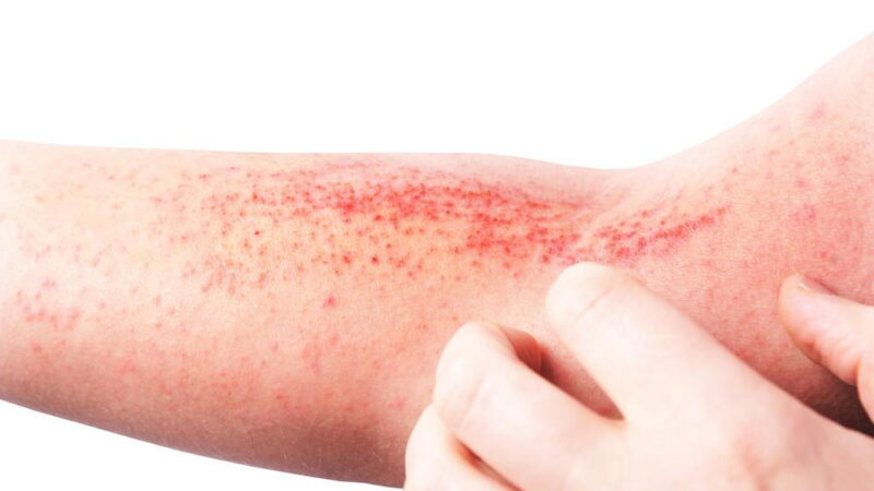Eczema Symptoms: Itchy, Dry Skin and Recurring Flare-Ups