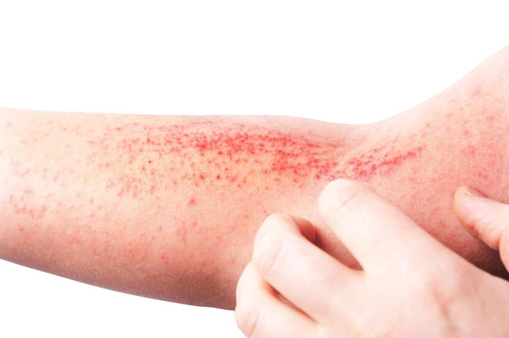 Eczema Symptoms: Itchy, Dry Skin and Recurring Flare-Ups