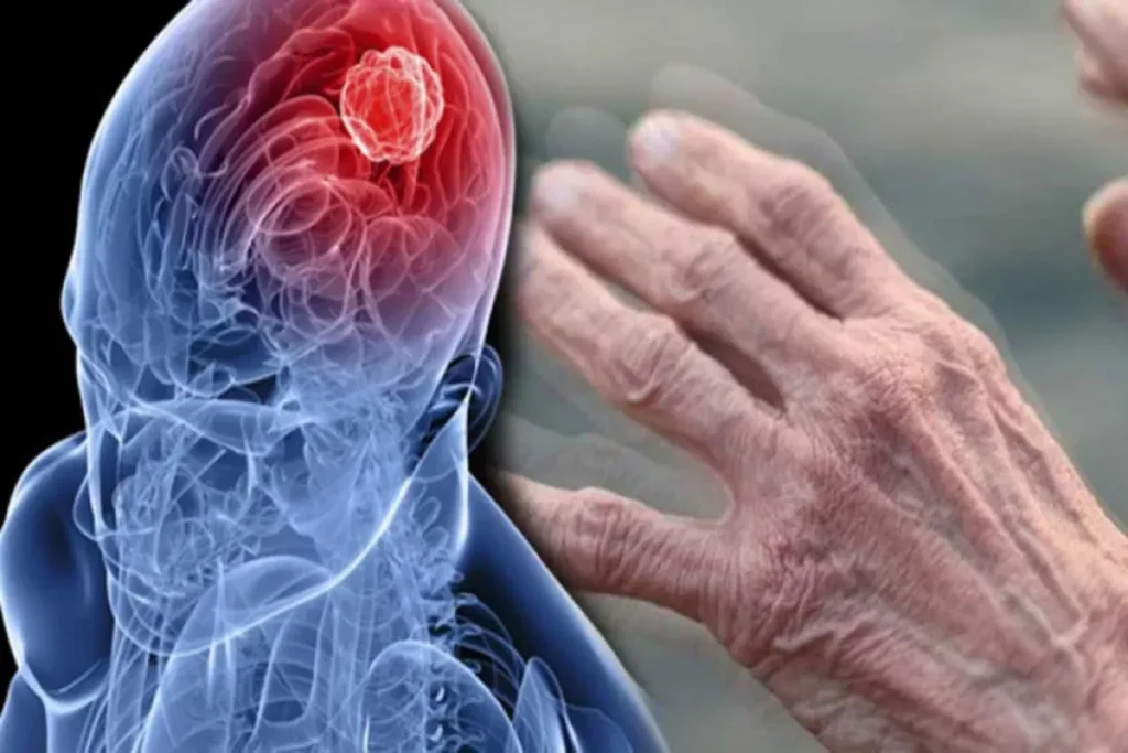 Parkinson's Disease Symptoms – Tremors And Movement Changes Explained