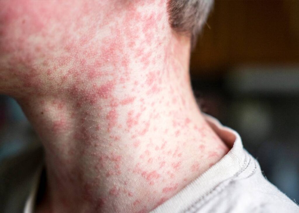 Measles Symptoms: Rash and Fever Timeline Explained