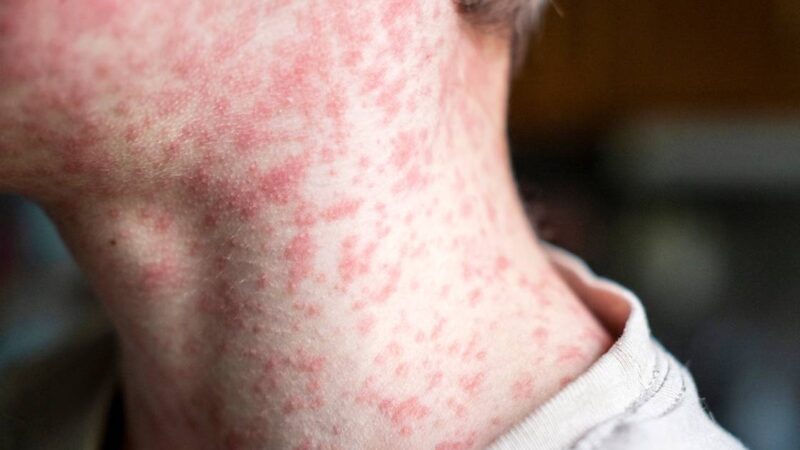 Measles Symptoms: Rash and Fever Timeline Explained