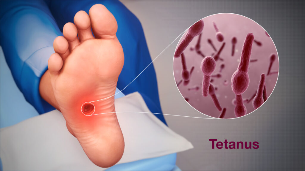 Tetanus Symptoms – Muscle Stiffness, Spasms and Lockjaw Signs