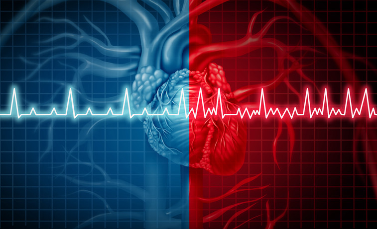 Arrhythmia Symptoms – Irregular Heartbeat Signs To Notice