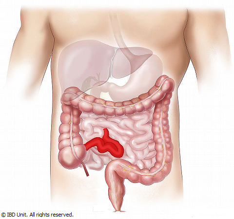 Crohn's Disease Symptoms – Digestive Flare Up Warning Signs
