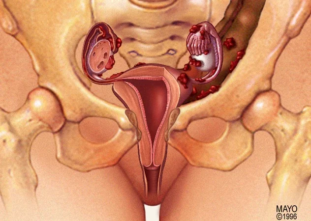 Endometriosis Symptoms – Pelvic Pain Doctors Often Dismiss