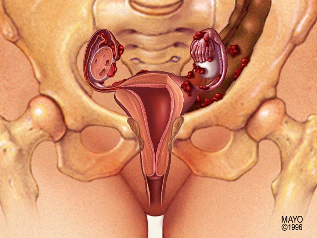 Endometriosis Symptoms – Pelvic Pain Doctors Often Dismiss